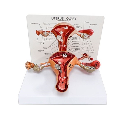 Picture of Realityworks Pathological Uterus Model